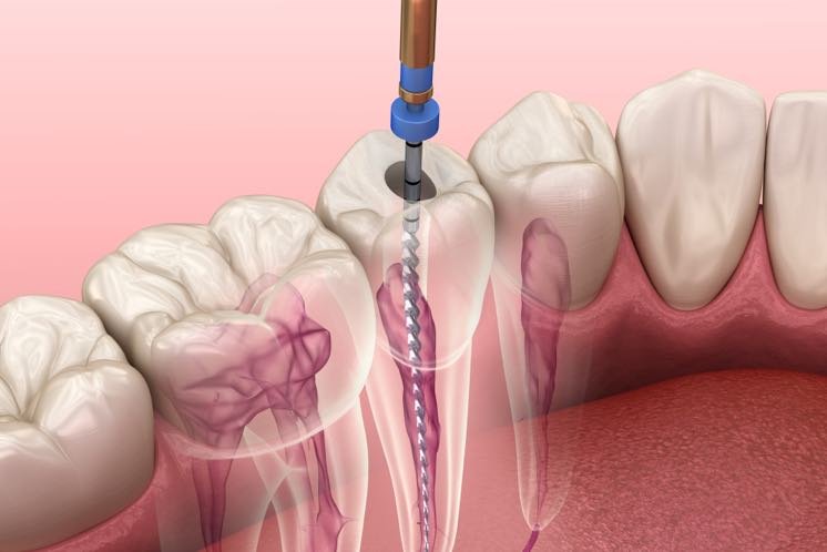 Endodoncia