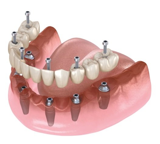 Implantes Dentales