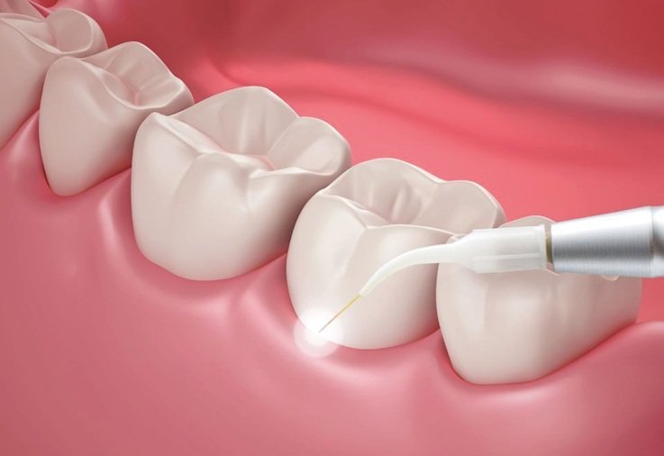 Láser Dental