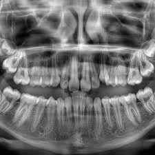 Radiología periapical