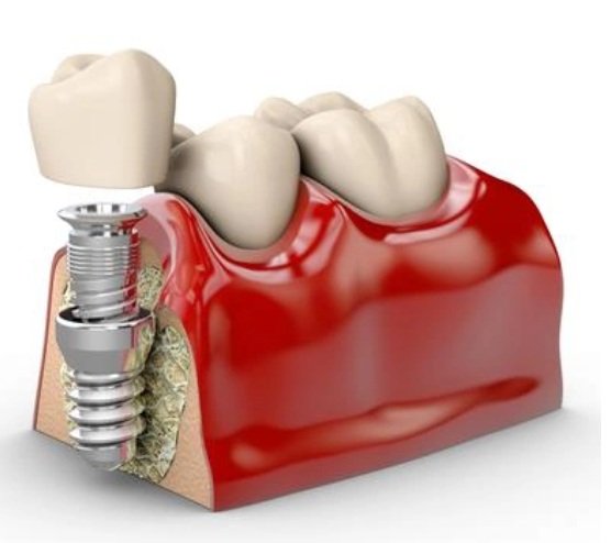 Rehabilitación Oral Digital